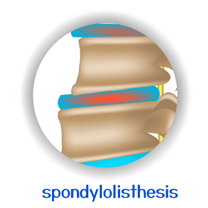 image of Williamson spondylolisthesis