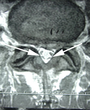 ligamentum flavum hypertrophy mri